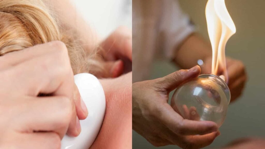 What Determines the Price of Cupping Therapy